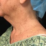 Neck Before & After Patient #1274