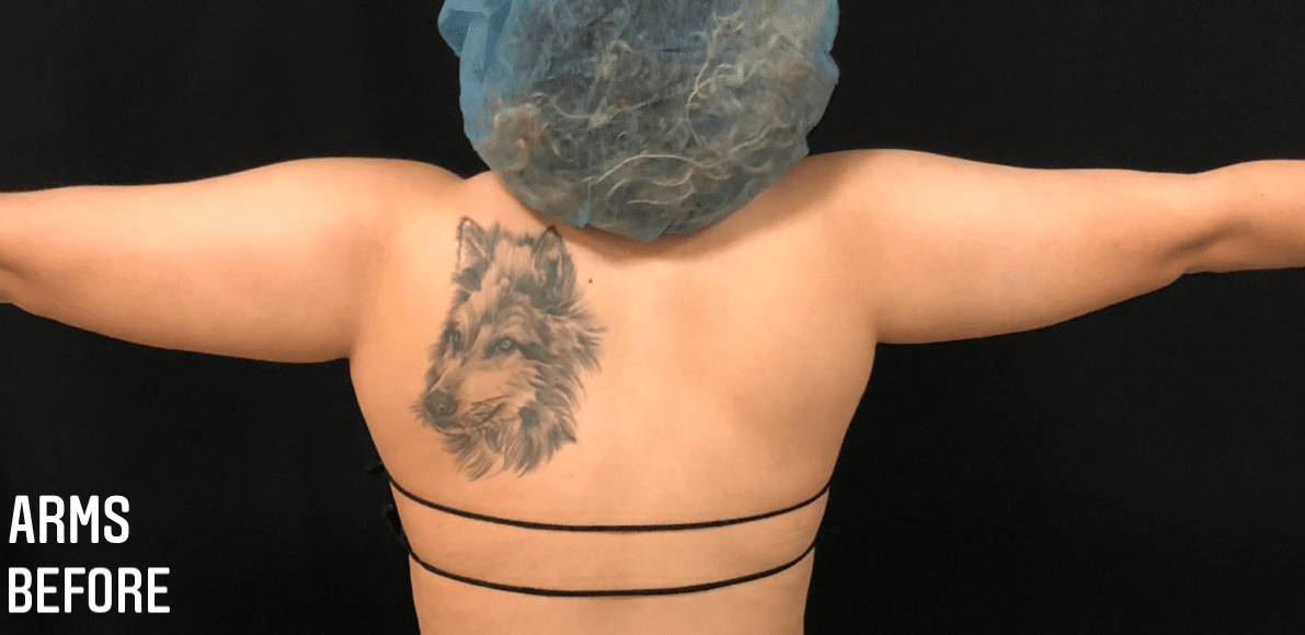 Arms Before & After Patient #1285