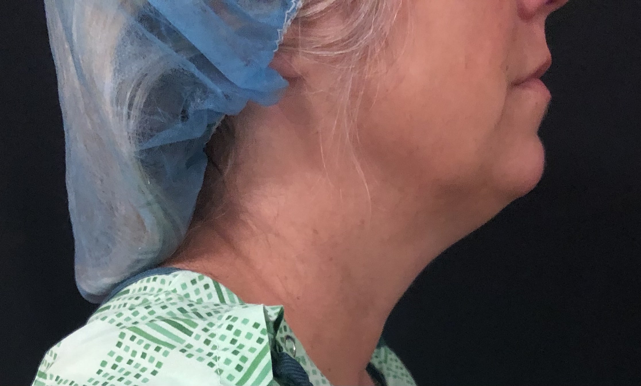 Neck Before & After Patient #1279