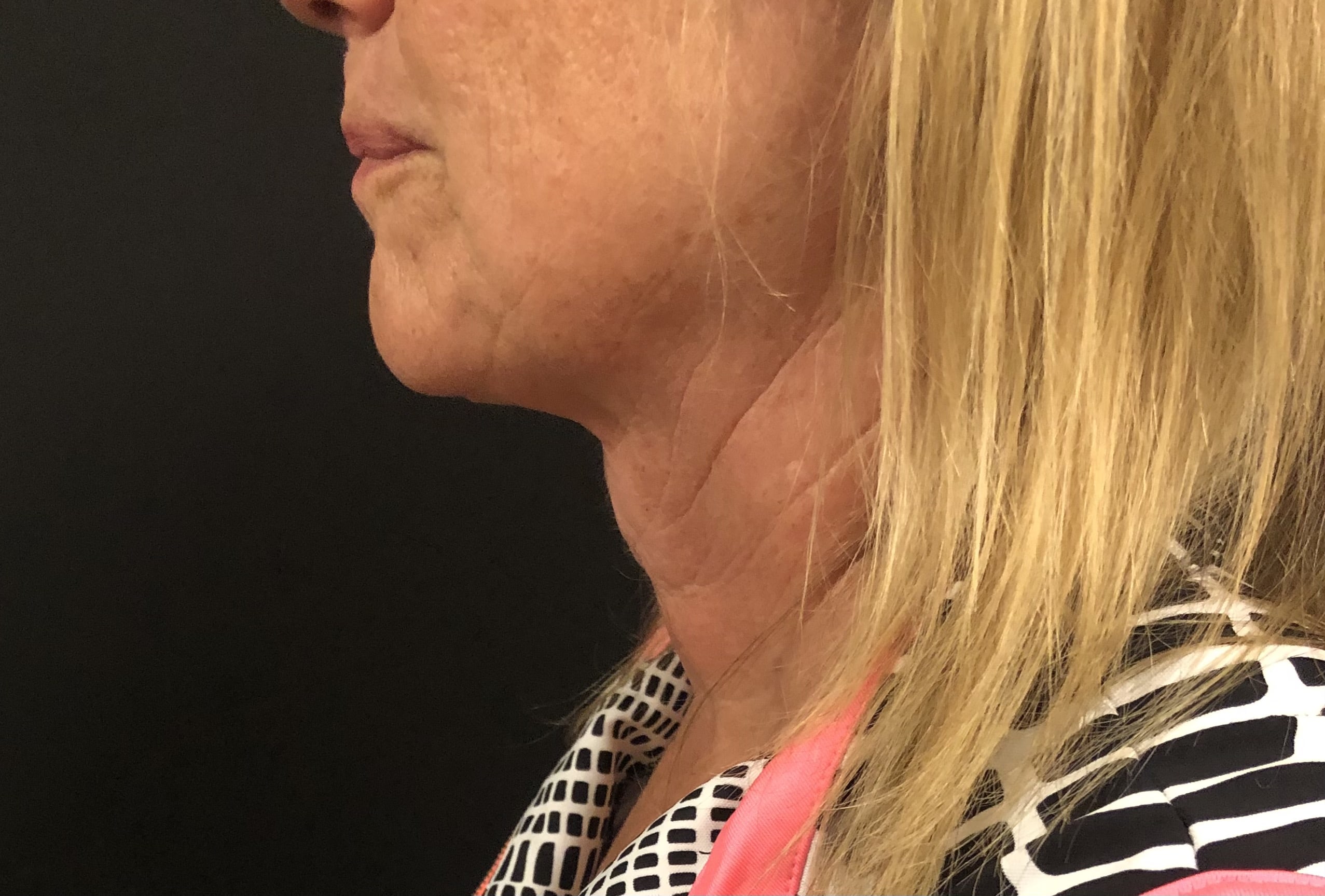 Neck Before & After Patient #1282
