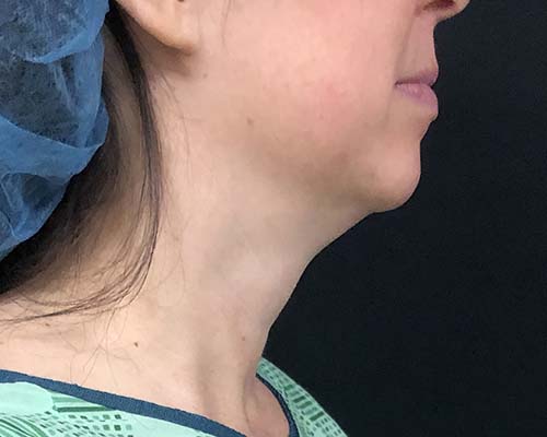 Renuvion Before & After Patient #1316