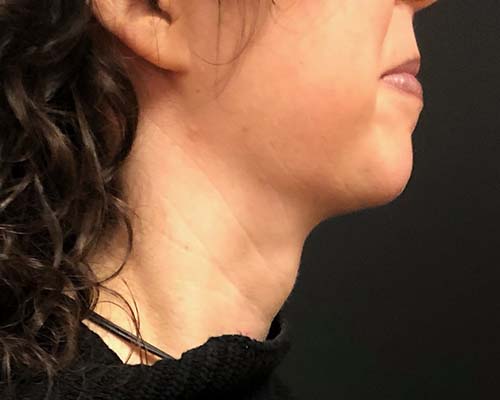 Renuvion Before & After Patient #1316