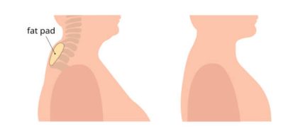 Buffalo Hump Liposuction Sacramento | NorCal Liposculpture