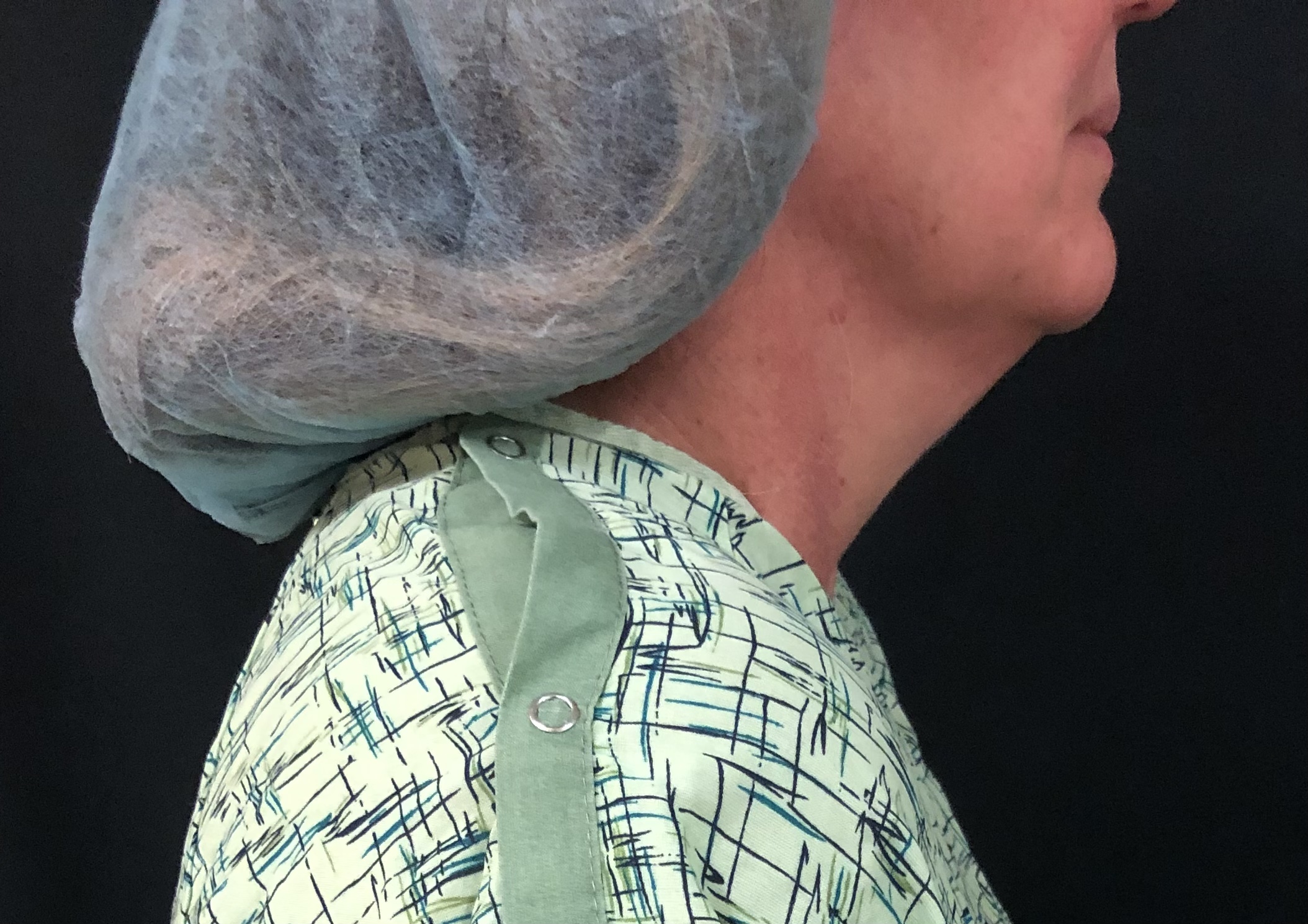 Neck Before & After Patient #1367