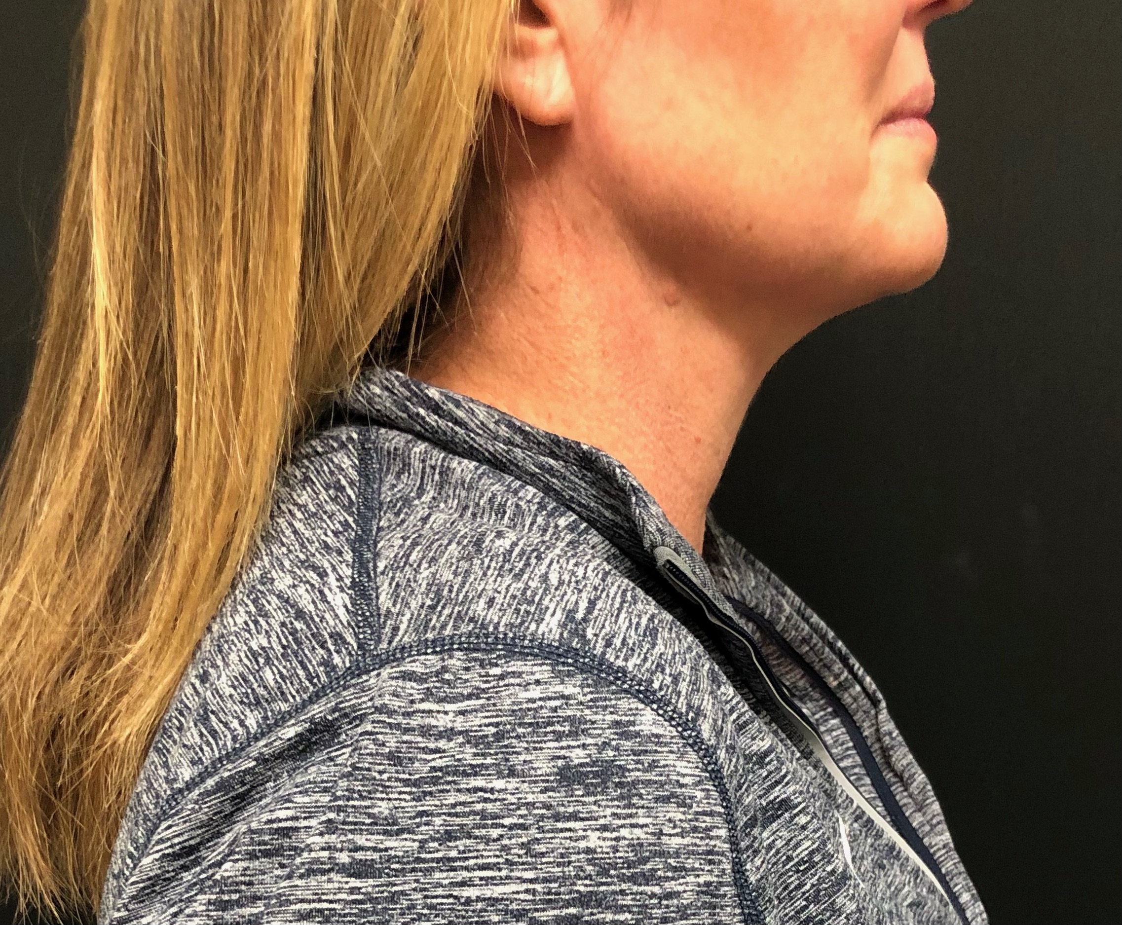 Neck Before & After Patient #1367
