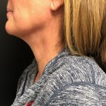 Neck Before & After Patient #1367