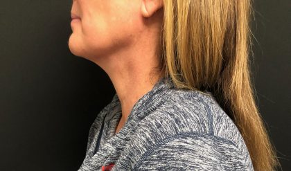 Neck Before & After Patient #1367