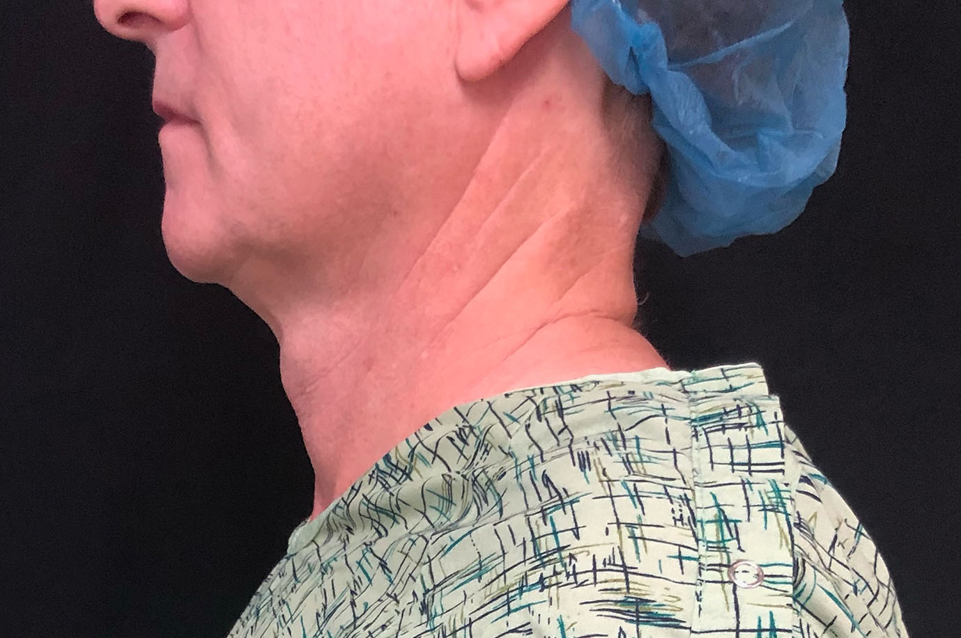 Neck Before & After Patient #1446