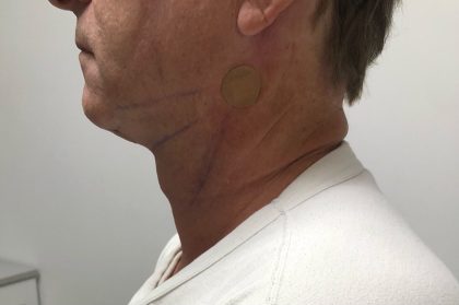 Neck Before & After Patient #1446