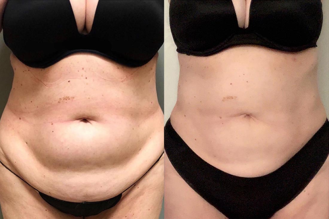 Seven-pound fat removal for - Chicago Lipedema Treatment