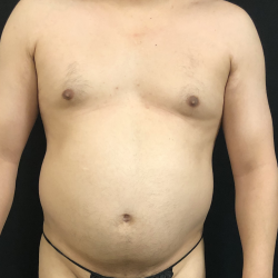 Abdomen Before & After Patient #1574