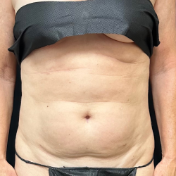 Abdomen Before & After Patient #1588