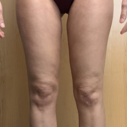 Legs Before & After Patient #1573