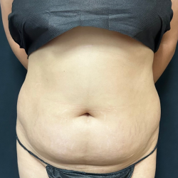 Abdomen Before & After Patient #1595
