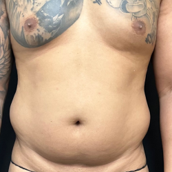 Abdomen Before & After Patient #1604