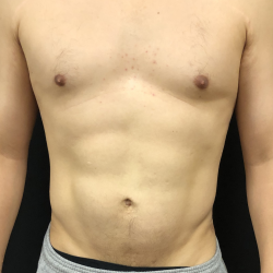 Abdomen Before & After Patient #1574