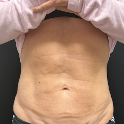 Abdomen Before & After Patient #1588
