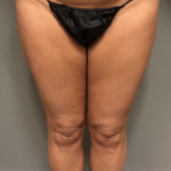 Legs Before & After Patient #1573