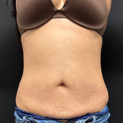 Abdomen Before & After Patient #1595