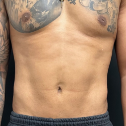 Abdomen Before & After Patient #1604