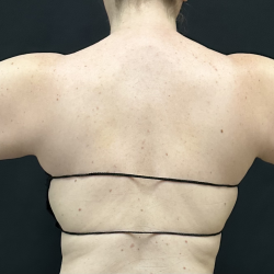 Arms Before & After Patient #1613