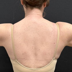 Arms Before & After Patient #1613