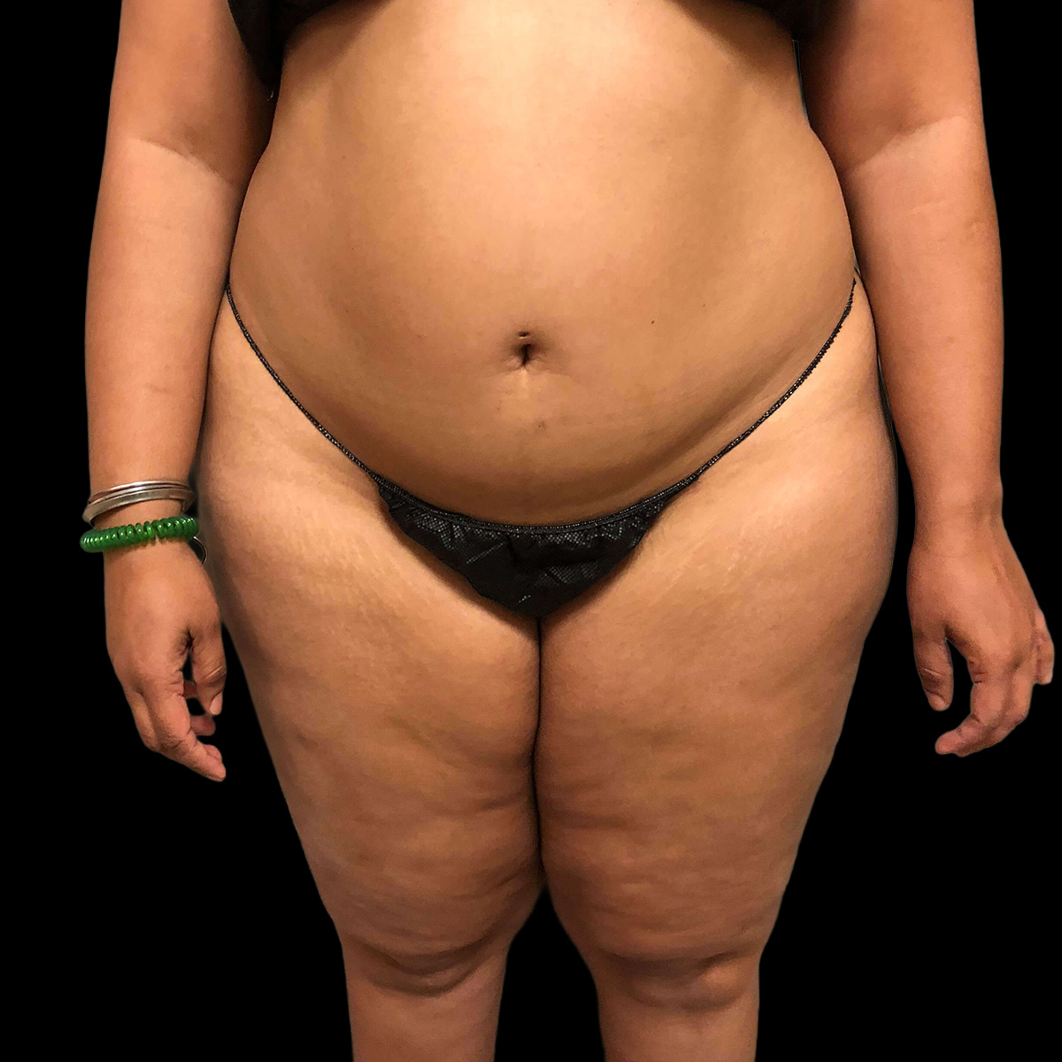 Patient before liposculpture treatment