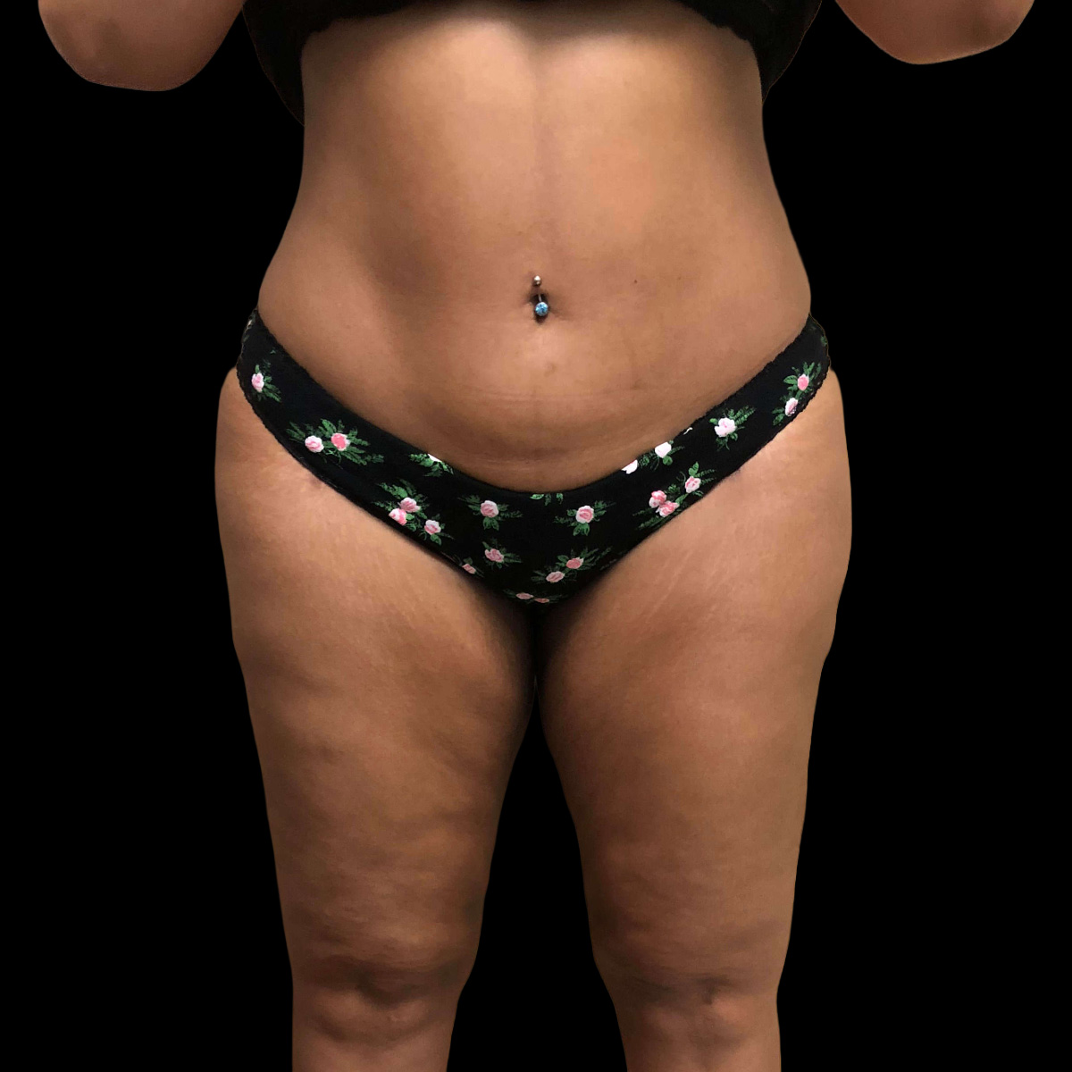 Patient after liposculpture treatment