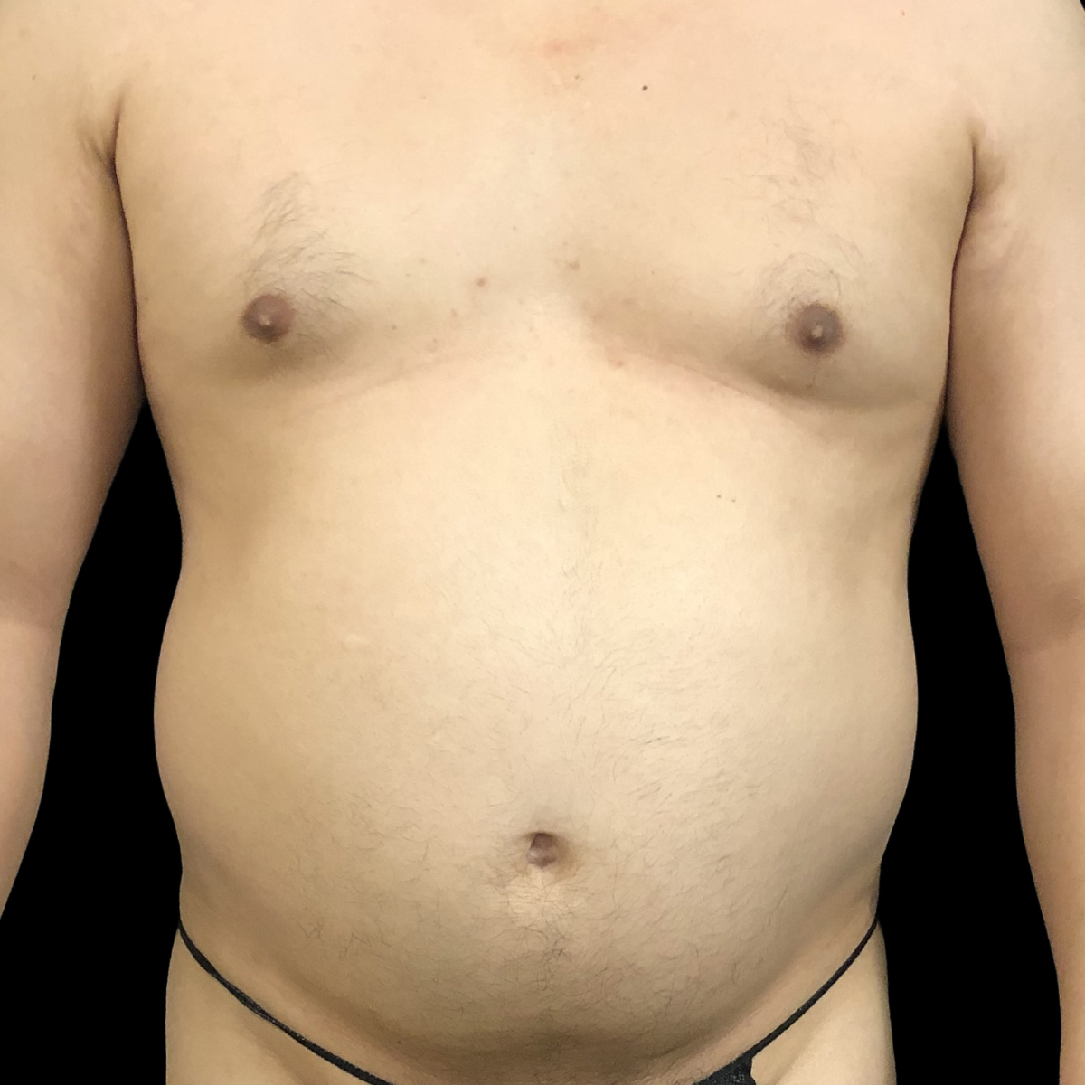 Patient before liposculpture treatment
