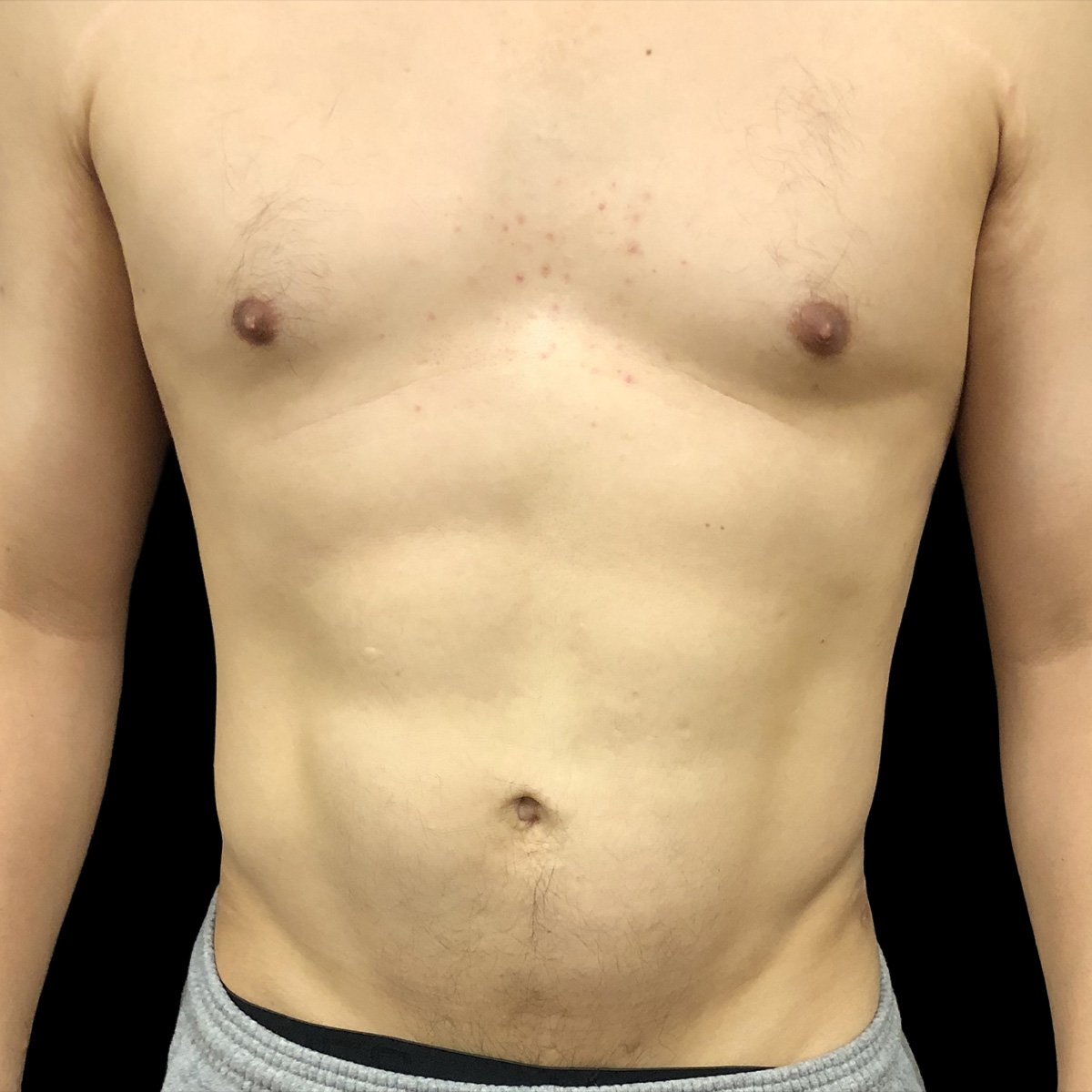 Patient after liposculpture treatment