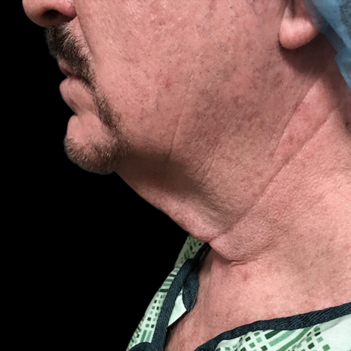 Patient before liposculpture treatment