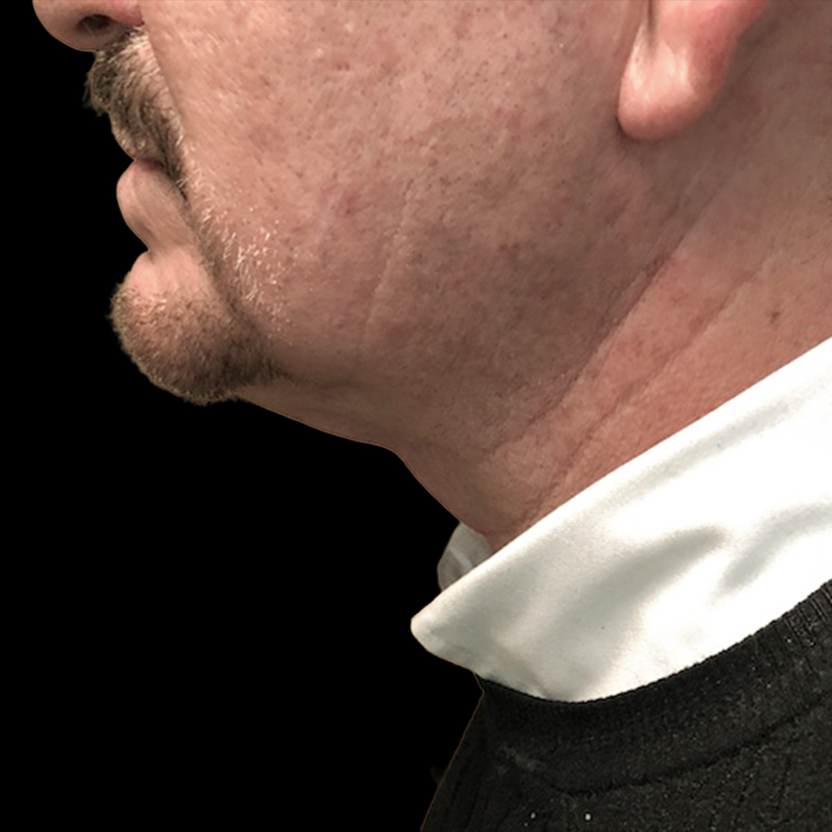 Patient after liposculpture treatment